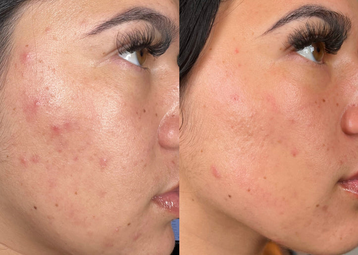 Authentic HydraFacial patient before and after results